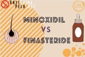 ¿Qué es Mejor Minoxidil o Finasteride?
